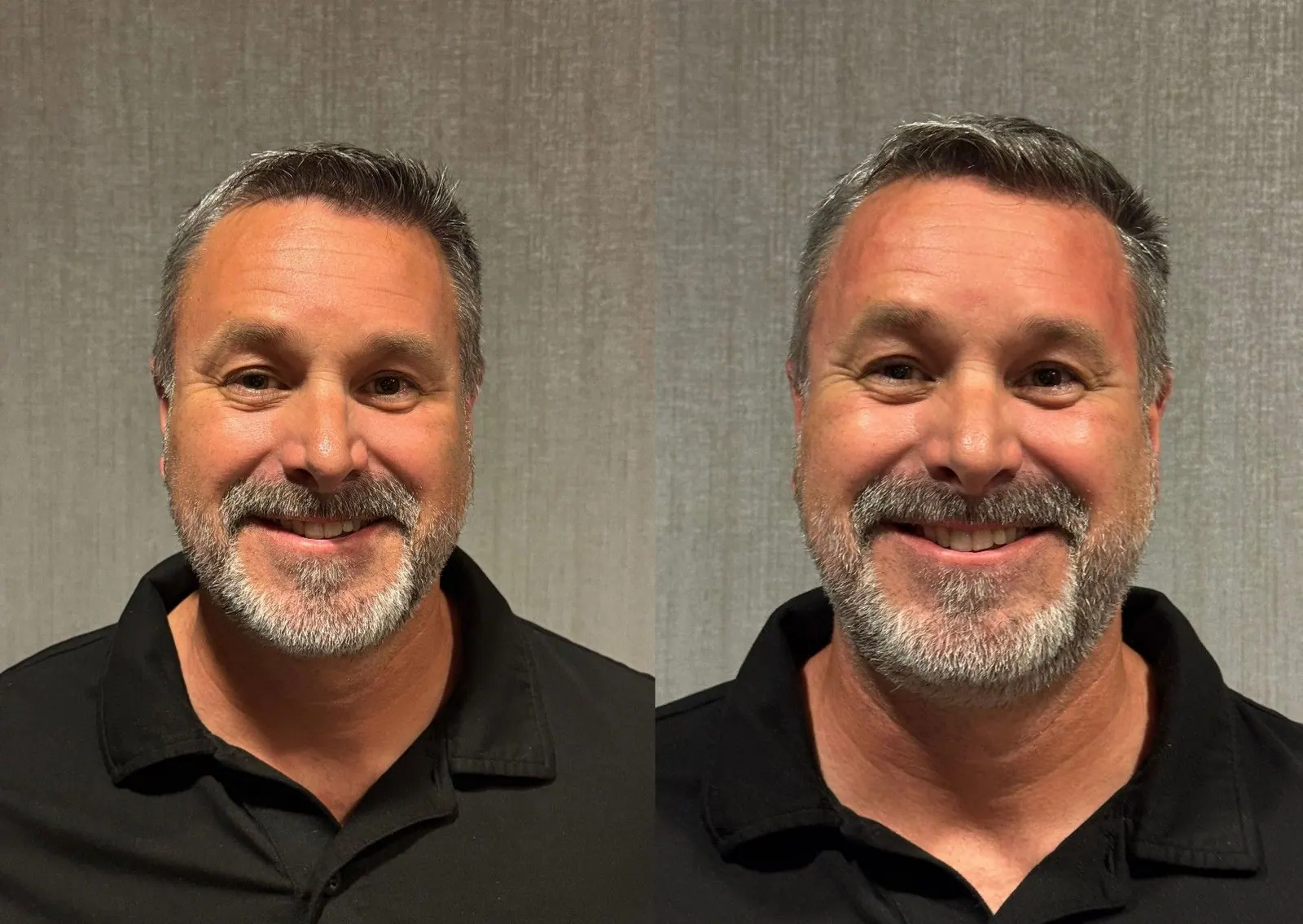 Temple Filler - Before & After